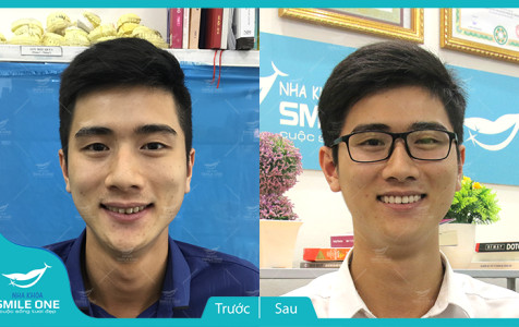 Hành trình “xóa sổ” răng khấp khểnh của chàng trai trẻ tại Nha khoa Smile One